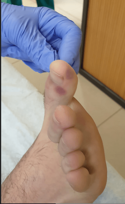 COV2 symptom could emerge on the feet